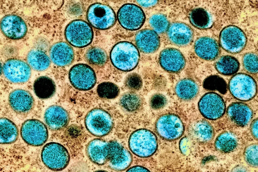 New, dangerous mpox strain spreads in DR Congo