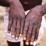 Burundi reports three mpox cases, health ministry confirms
