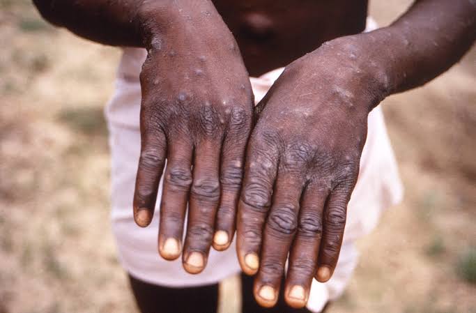 Burundi reports three mpox cases, health ministry confirms