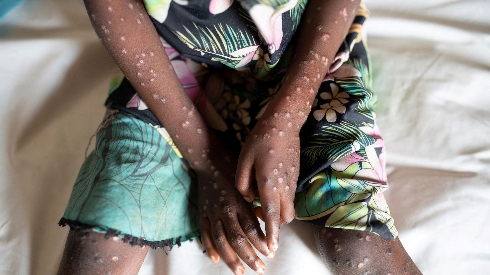 Sierra Leone reports 2,000+ mpox cases and 11 deaths in 2025