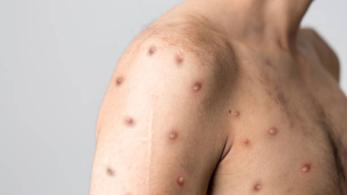 Mpox cases surge 545% in Africa — Africa CDC