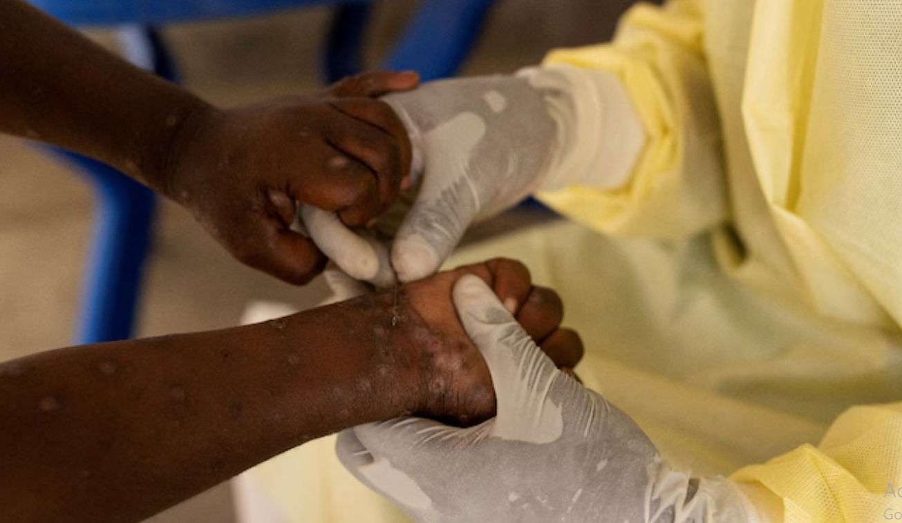 Africa CDC commits to eradicating mpox from Africa by 2025