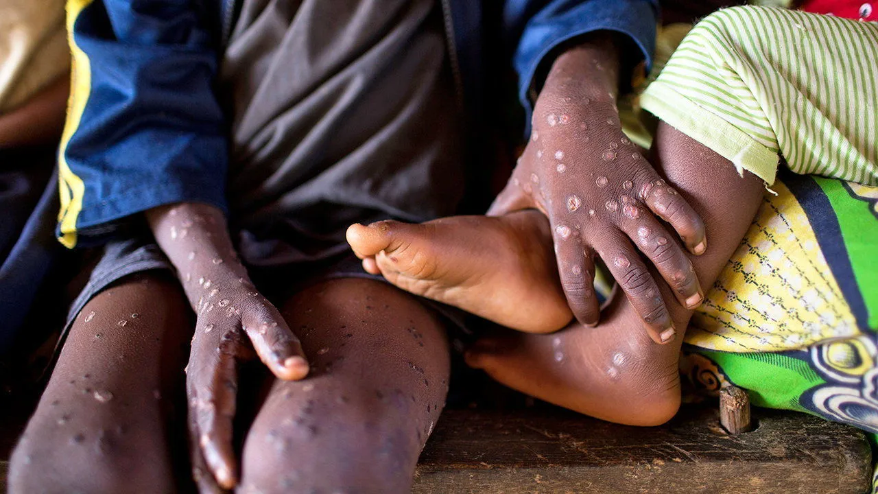 Mpox testing capacity stalls in DRC amid rising cases