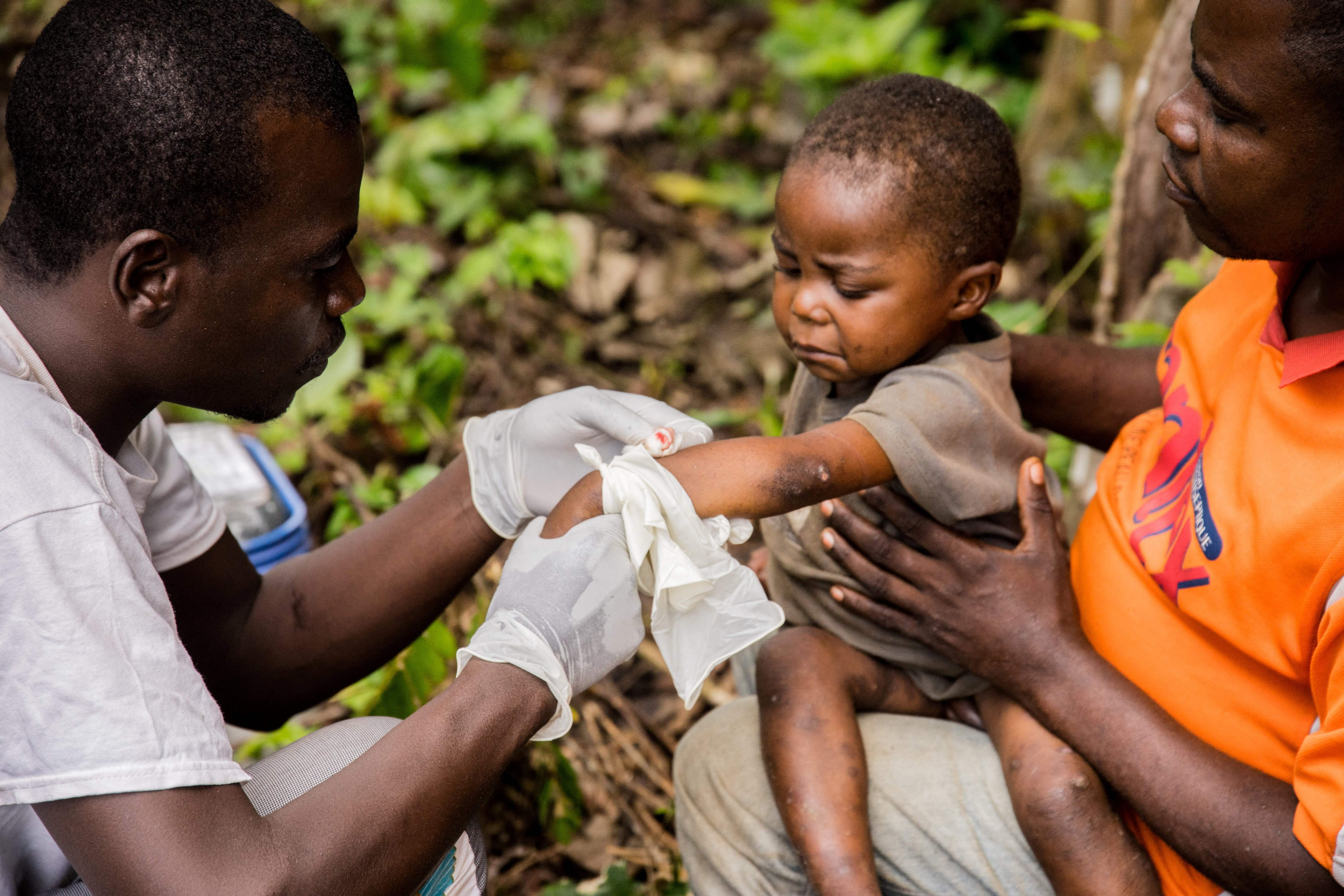 Infant, mother test positive in Ethiopia’s first mpox outbreak