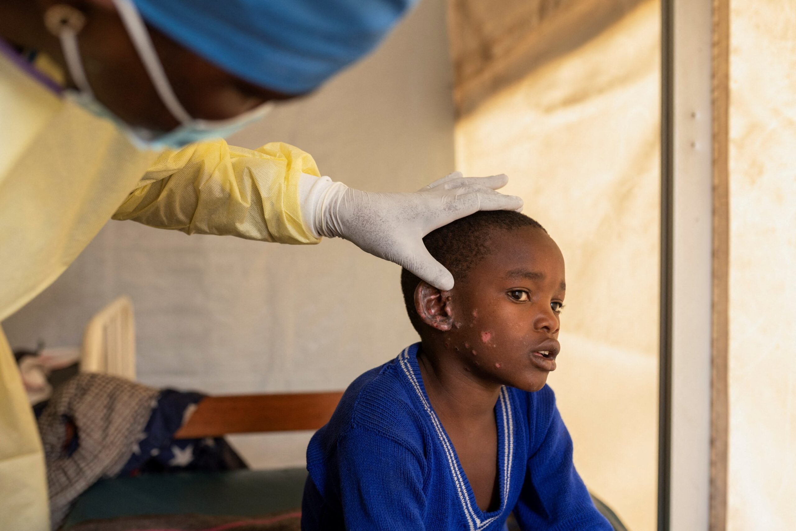 WHO: Mpox vaccination drive underway in Africa