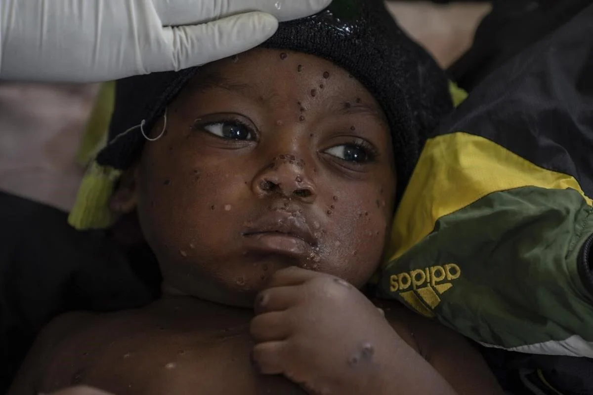 Mpox detected in Sierra Leone for the first time since global alert