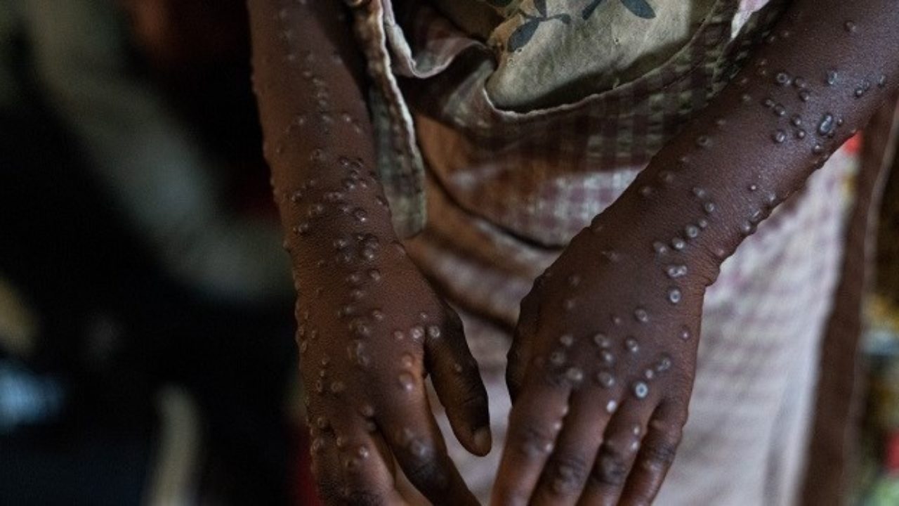 WHO warns funding gaps hinder Africa’s fight against mpox spread