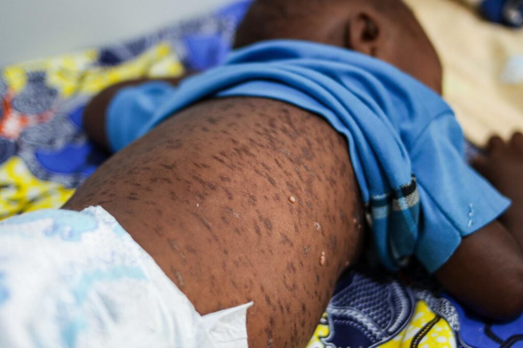 Cabo Verde, Mauritius, Seychelles eliminate measles and rubella